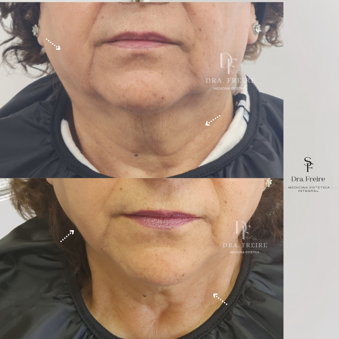 Reduce Grasa facial localizada Reduce grasa facial con mini inyecciones