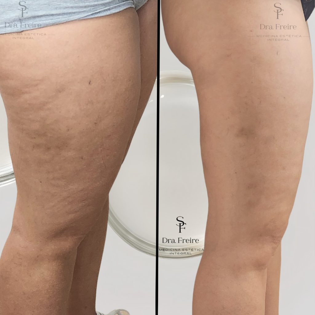 Reducción de Celulitis sin cirugía