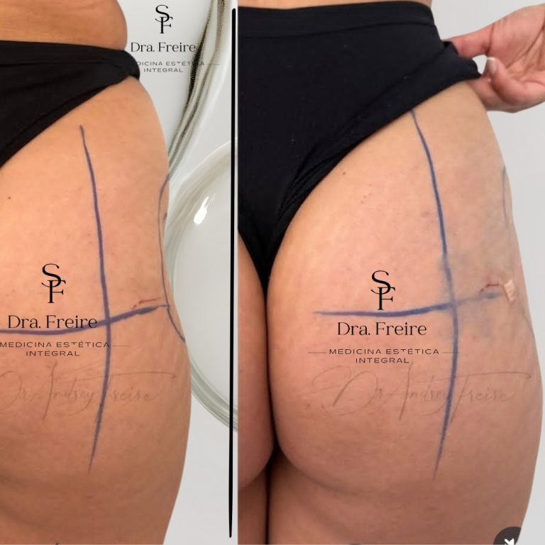 Relleno Glúteo y/o caderas (hip dips) Con ácido hialurónico corporal