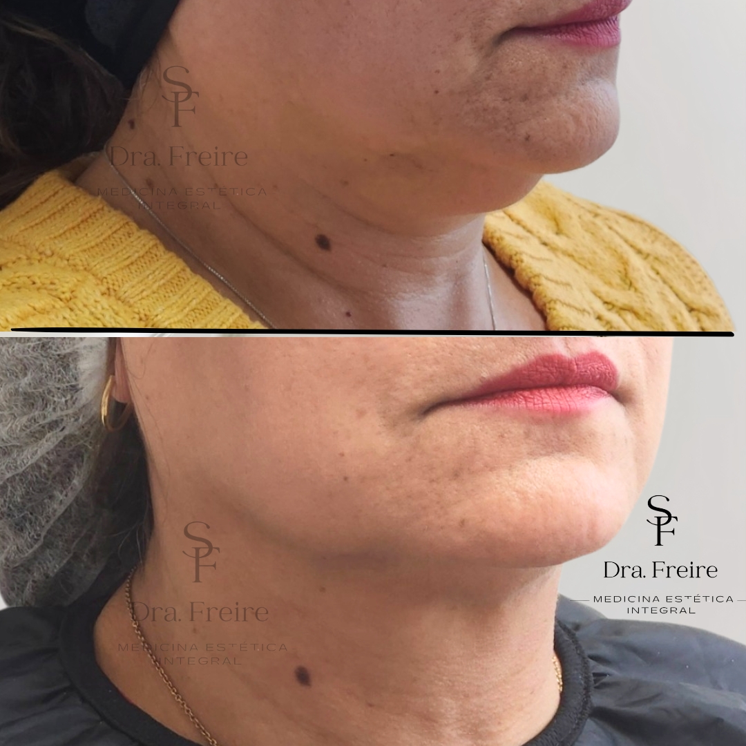 Lipopada sin cirugía Lipopapada sin cirugía